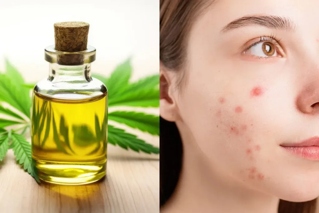 Face oil for acne prone skin | Facial Oil