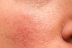 Skin treatment for sensitive skin