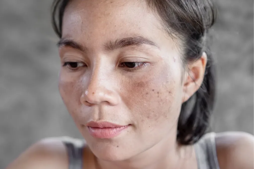 How to remove pigmentation from face permanently naturally at home