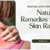 Natural remedies for skin rash