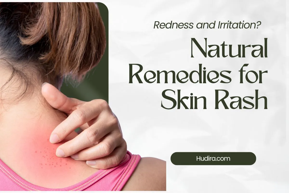 Natural remedies for skin rash