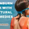 Natural sunburn remedies