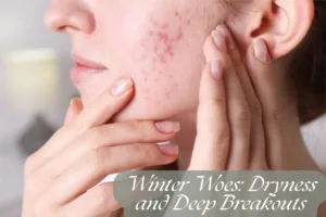 Winter Woes Dryness and Deep Breakouts
