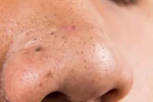 Blackhead remover in a herbal way