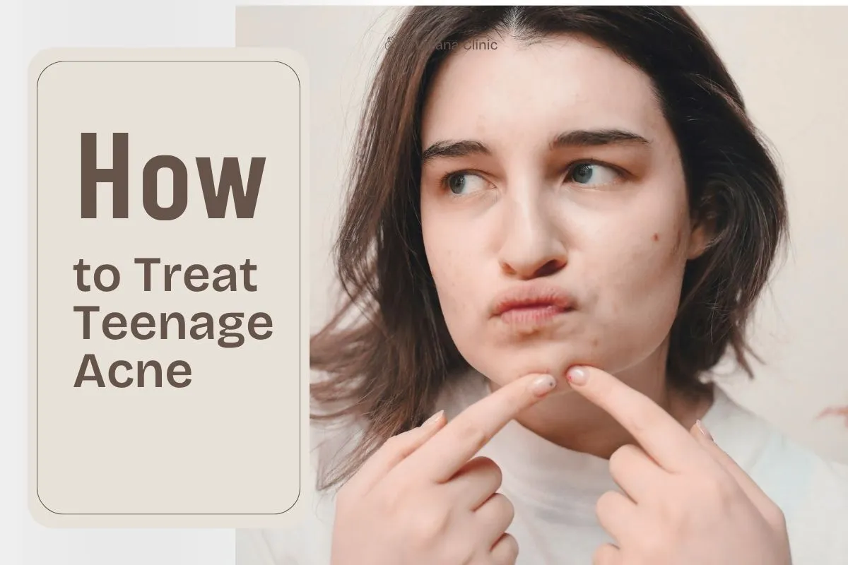 How to Treat Teenage Acne | Skincare for Teens