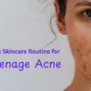 Best Skincare Routine for Teenage Acne