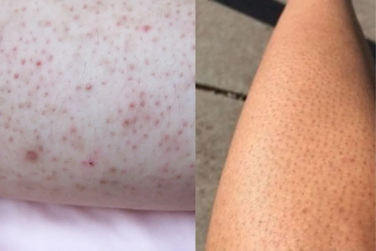 Strawberry legs showing clogged pores and strawberry spots on skin after shaving