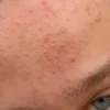 Fungal acne treatment showing small uniform bumps on forehead
