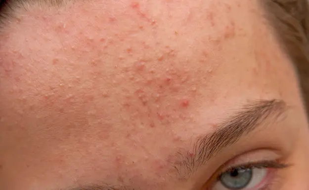 Fungal acne treatment showing small uniform bumps on forehead