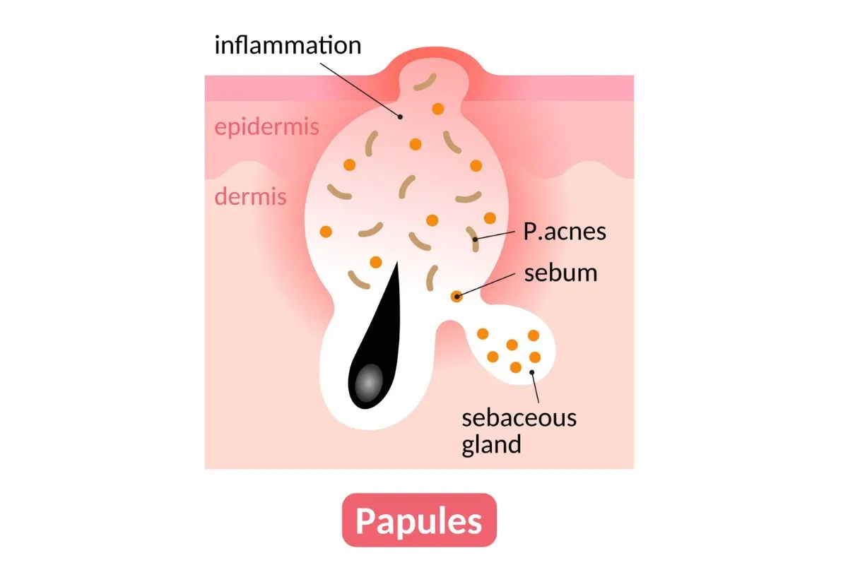 How acne occur on face