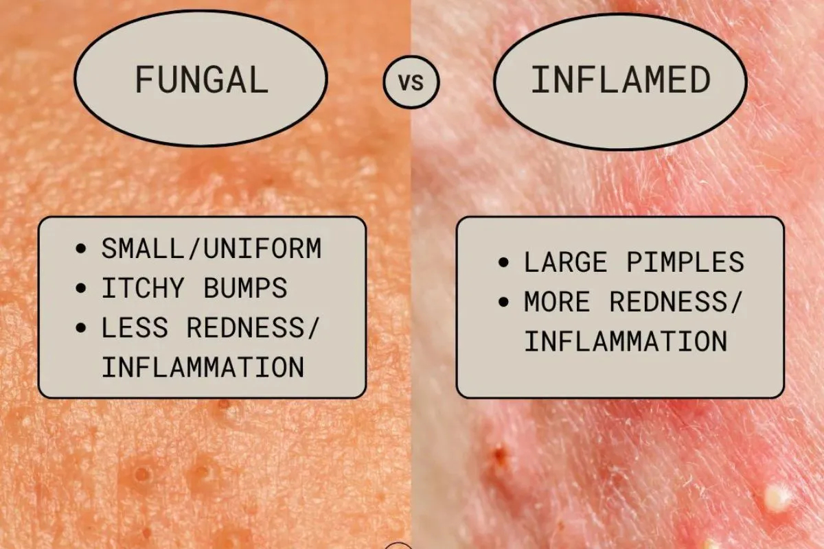Fungal Acne on Face vs Regular Acne