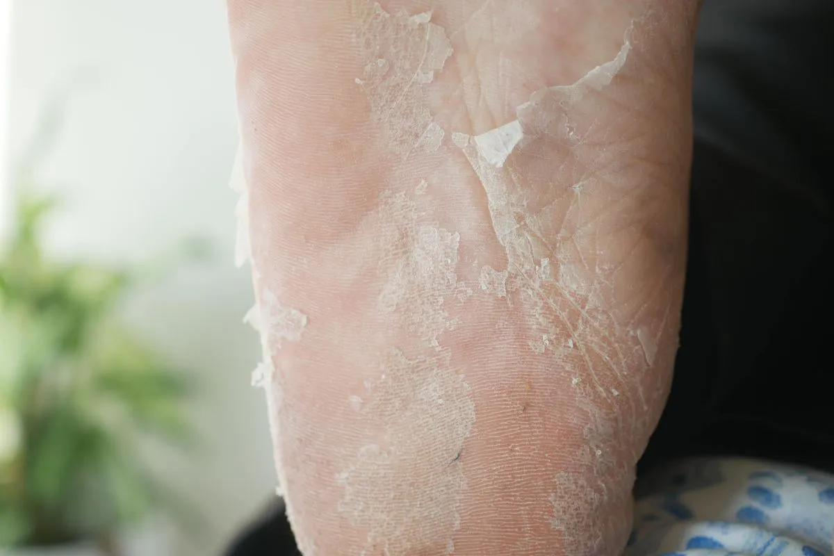 How to remove dead skin from feet