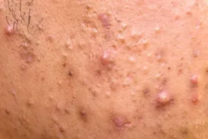 What Makes a Good Pimple Mask?