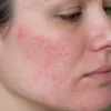 Natural remedies for inflamed skin