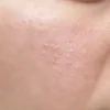 How to remove whiteheads on face permanently | Hudira