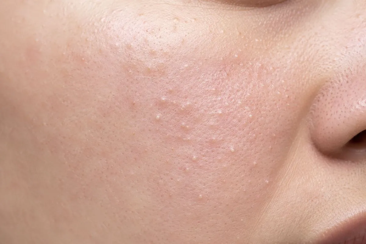 How to remove whiteheads on face permanently | Hudira