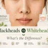 Blackheads vs Whiteheads: What Is the Difference?