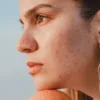 How to Fade Ingrown Hair Scars Gently and Safely?