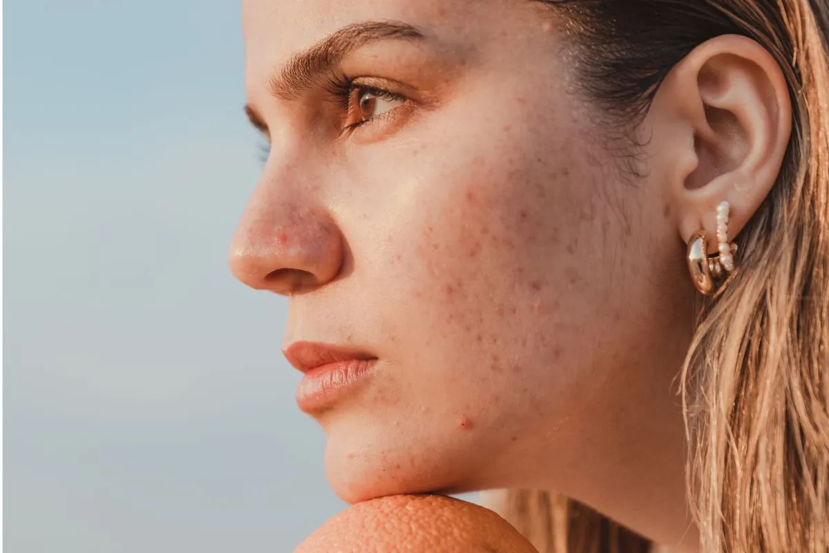 How to Fade Ingrown Hair Scars Gently and Safely?