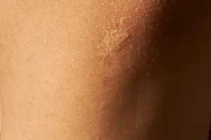 How to Fade Ingrown Hair Marks Gently and Safely