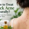 How to Treat Back Acne Naturally?
