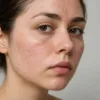How to Fix Rough Patches on Skin