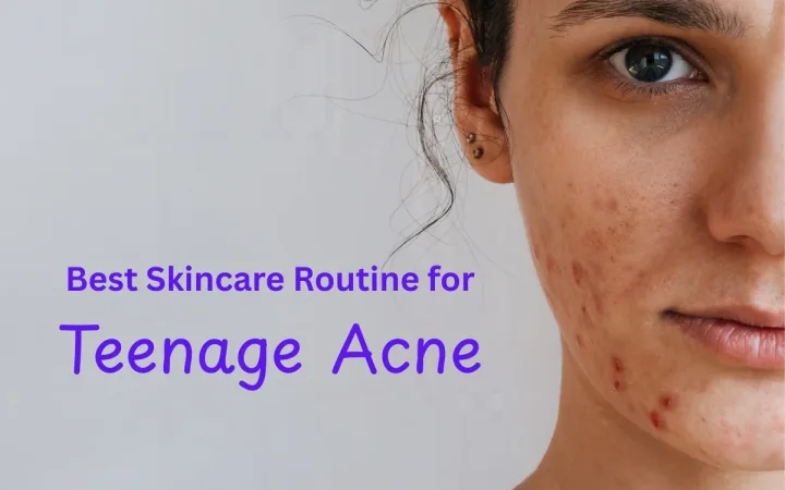 Best Skincare Routine for Teenage Acne
