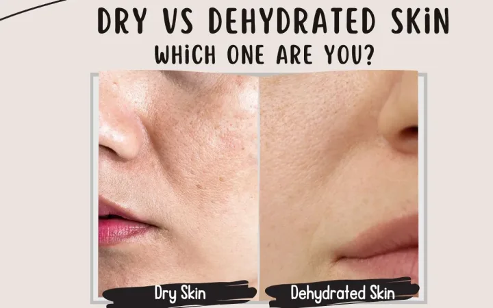 Dry vs Dehydrated skin
