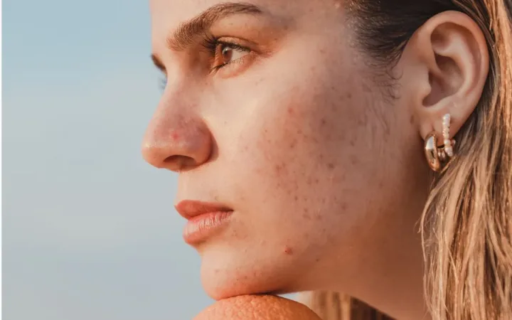 How to Fade Ingrown Hair Scars Gently and Safely?