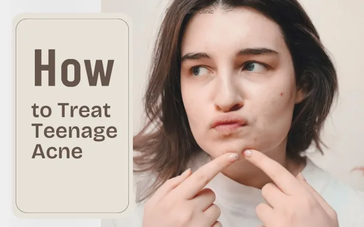 How to Treat Teenage Acne How to Treat Teenage Acne | Skincare for Teens