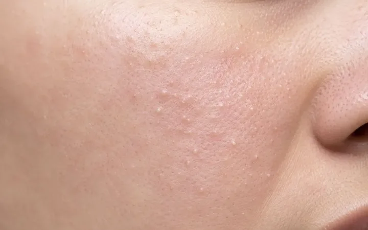 How to remove whiteheads on face permanently | Hudira